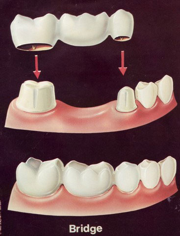 Bridge Tooth