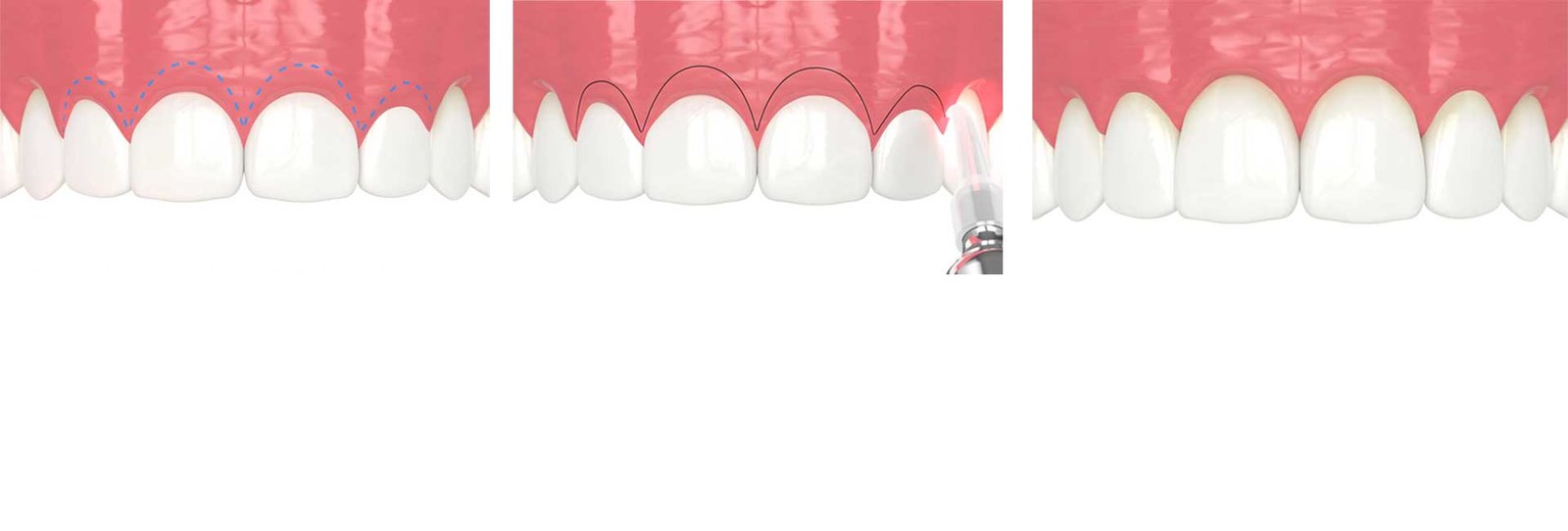 3D rendering of the step-by-step procedure of laser treatment for gummy smile in the upper jaw and creation of a new gum line