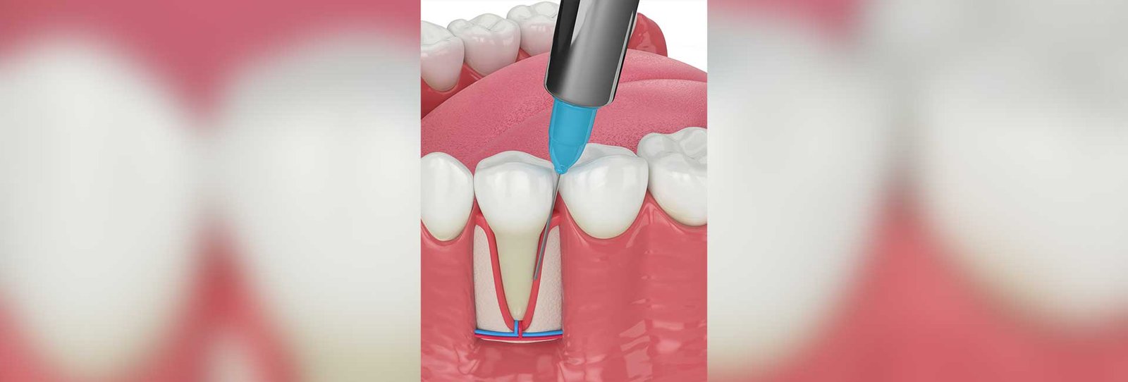 3d render of human jaw with intraligamentary anesthesia procedure over white background