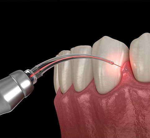Gum correction surgery with laser