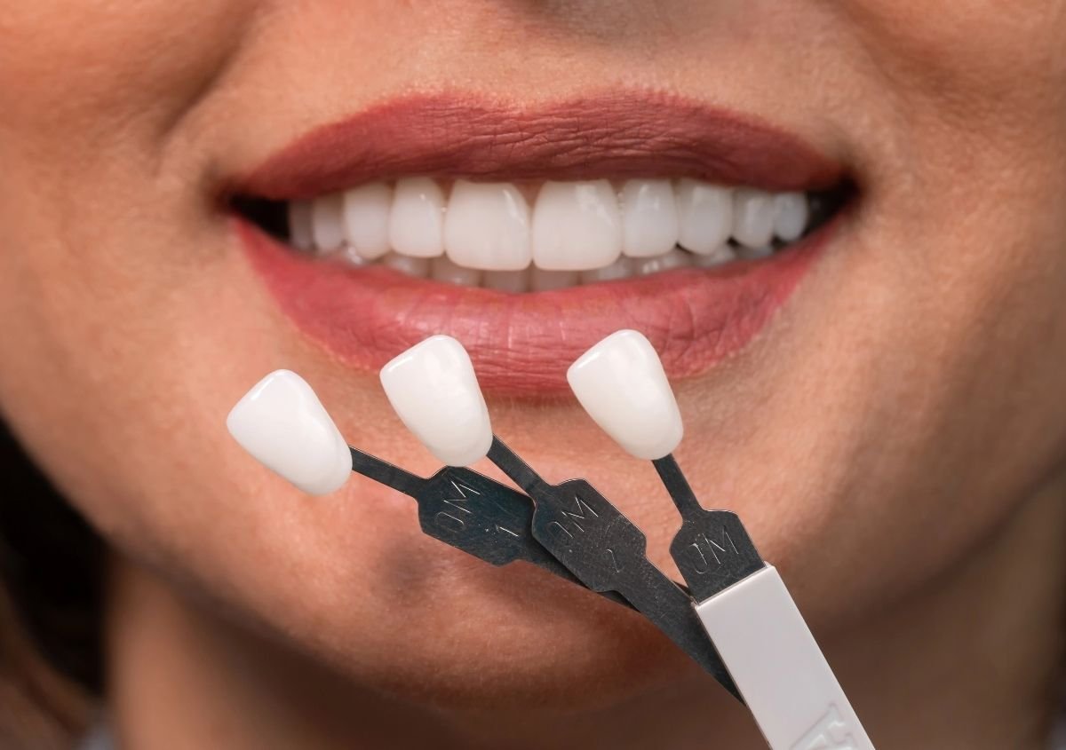 Unveil Your Beautiful Smile with High-quality Porcelain Veneers